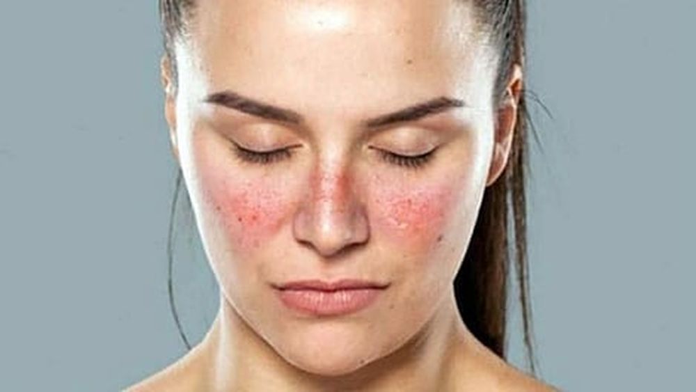 Michoacán, entre los estados que respaldan iniciativas sobre lupus